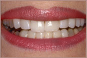 veneers-after