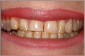 veneers-before