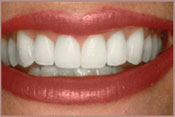 whitening-after