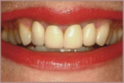 whitening-before