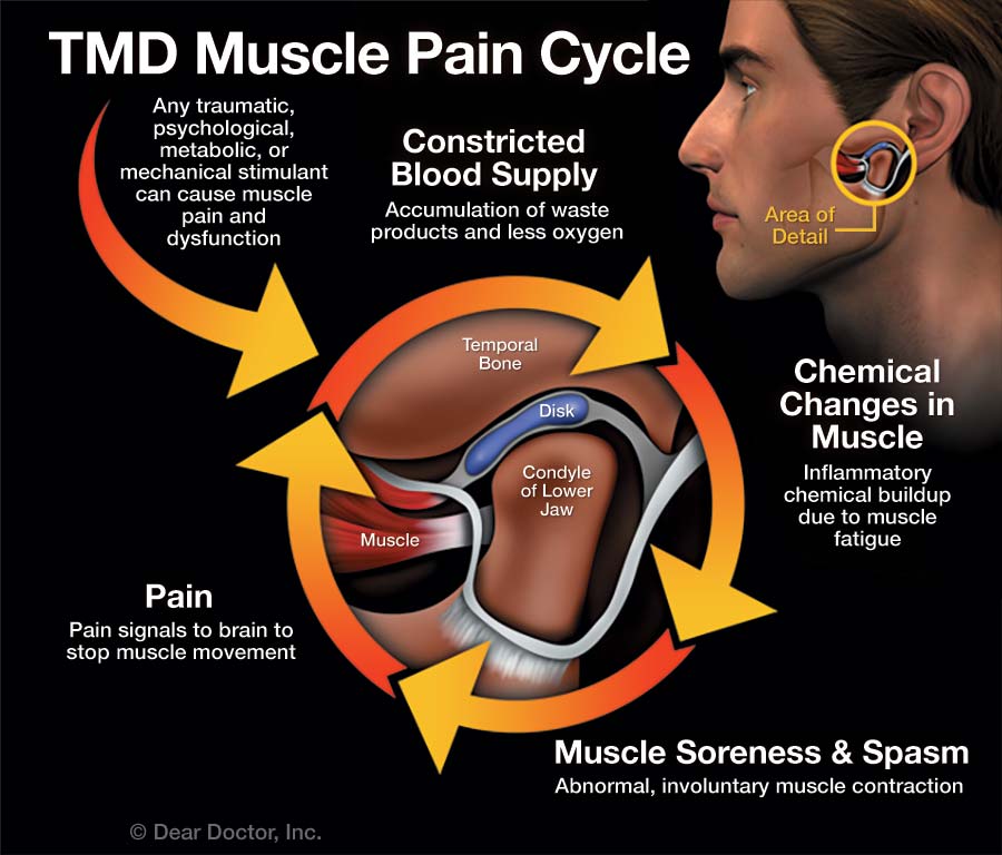 TMD Muscle Pain Cycle.